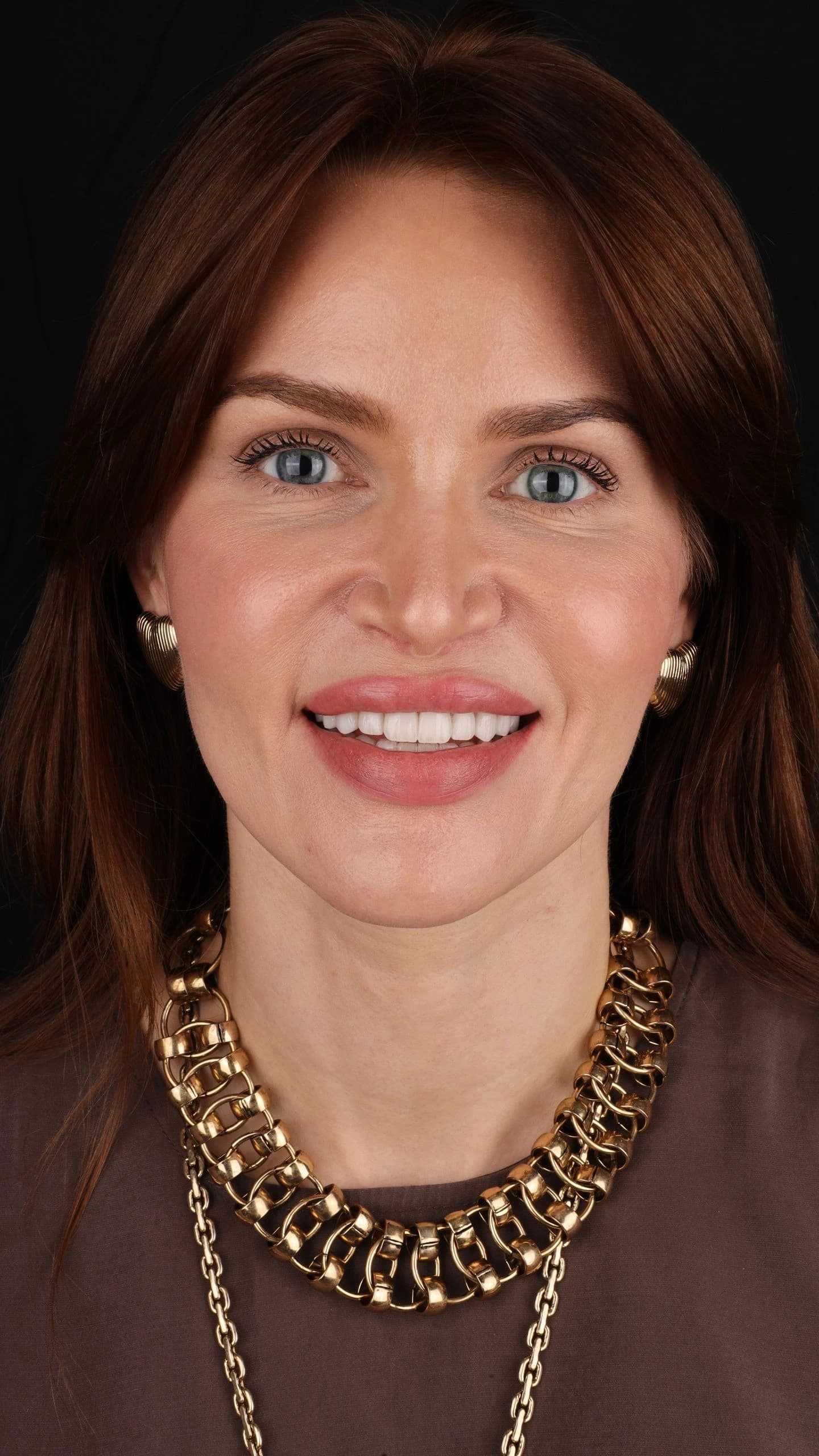 Patient smile result 22