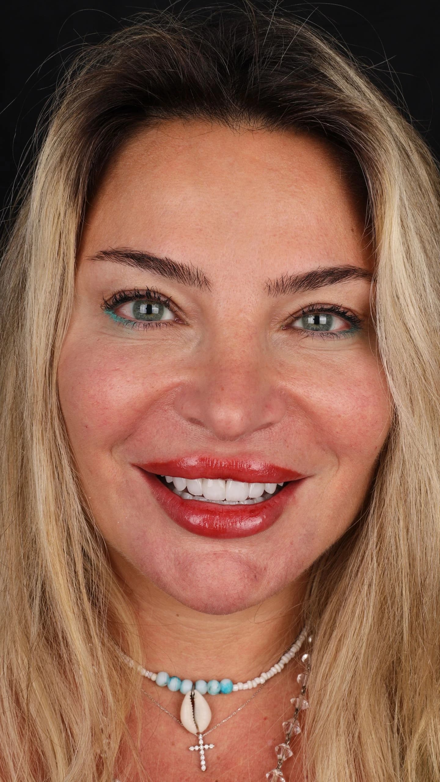 Patient smile result 35