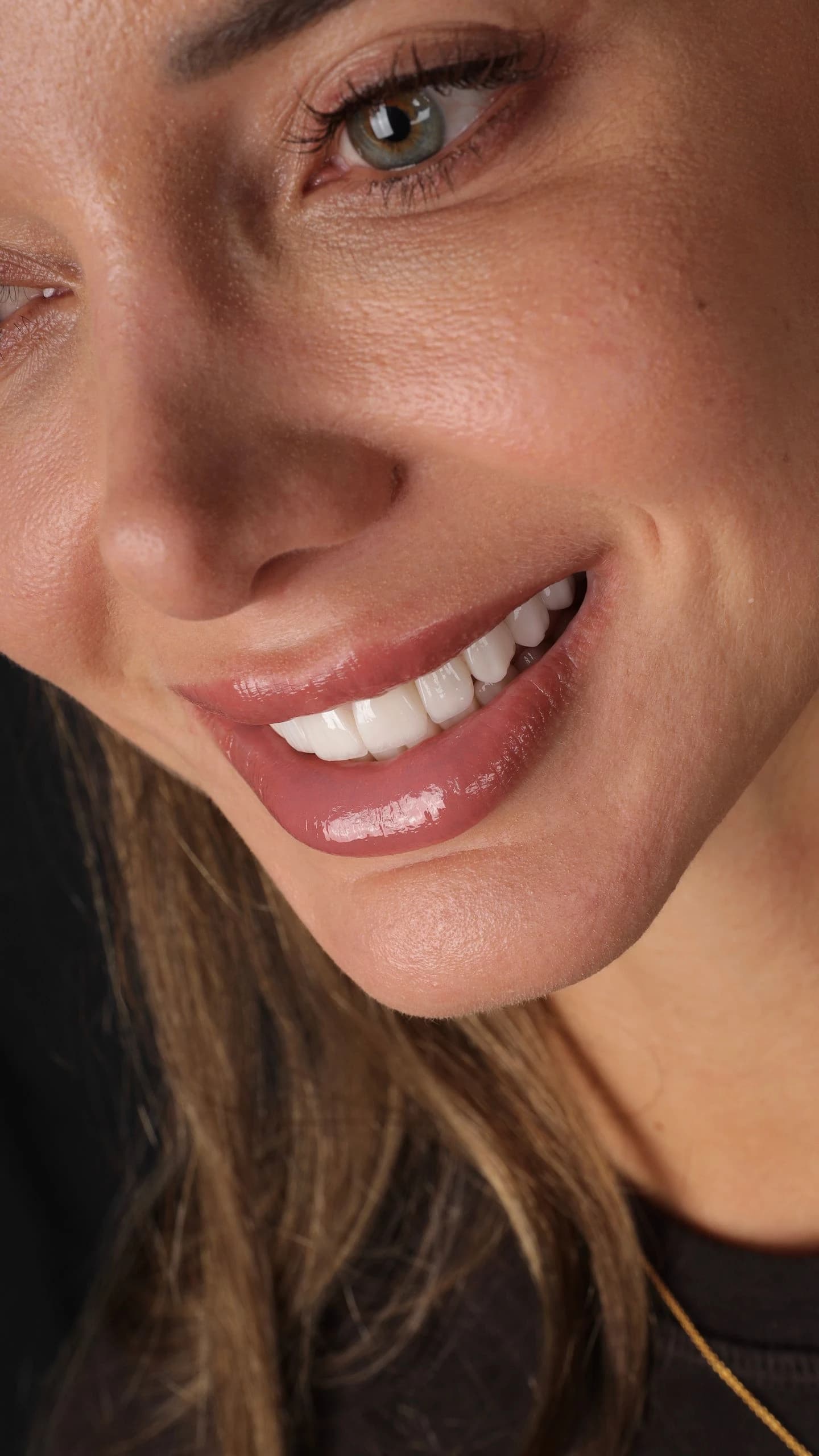 Patient smile result 34