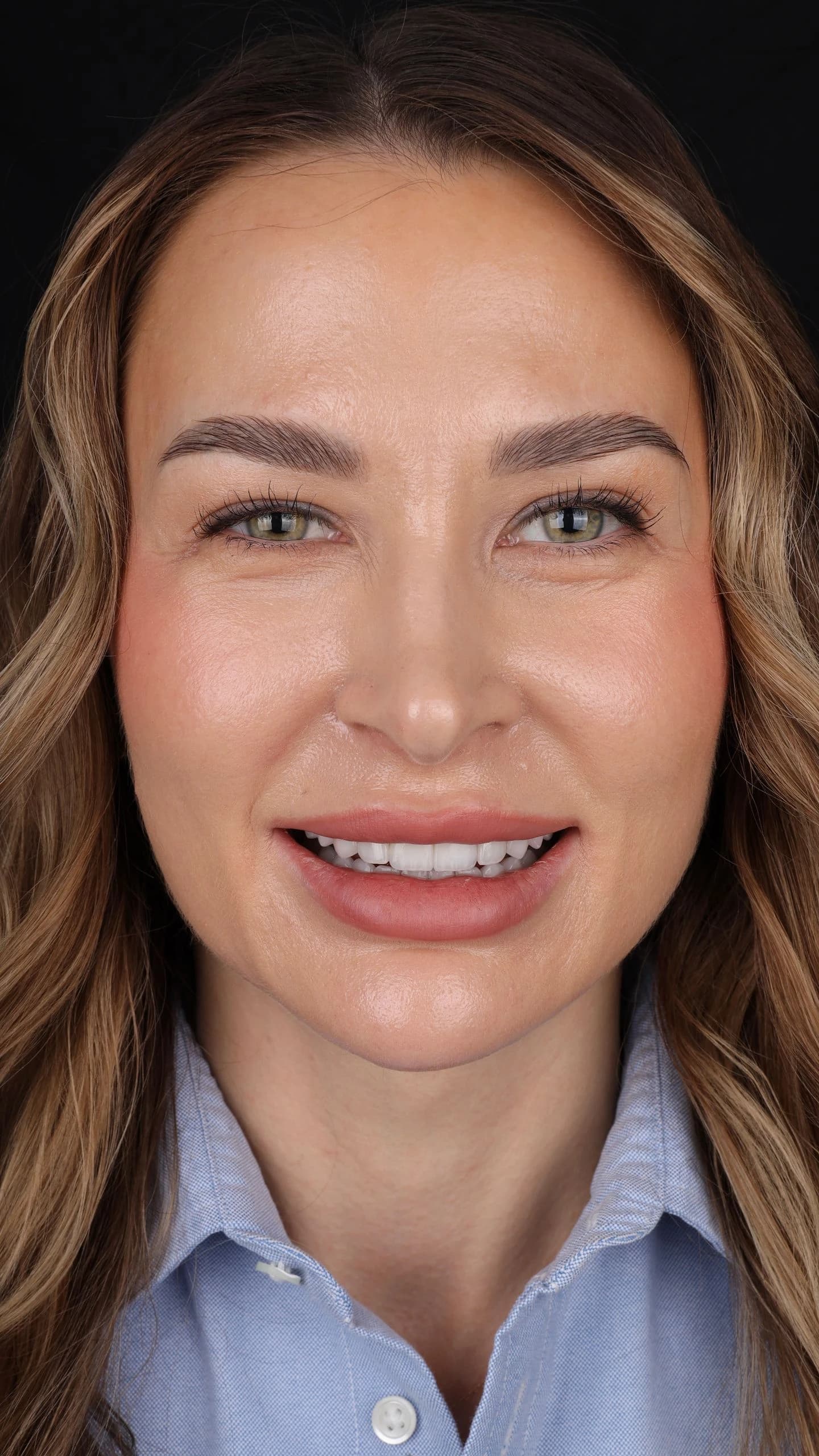 Patient smile result 33