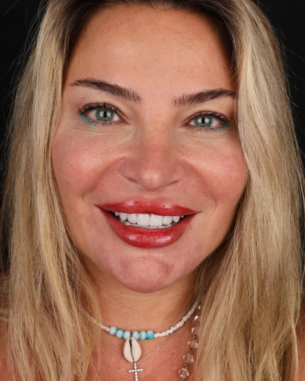 Patient smile result 8